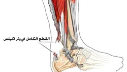 ما يجب معرفته عن اصابة وتر اخيل ؟